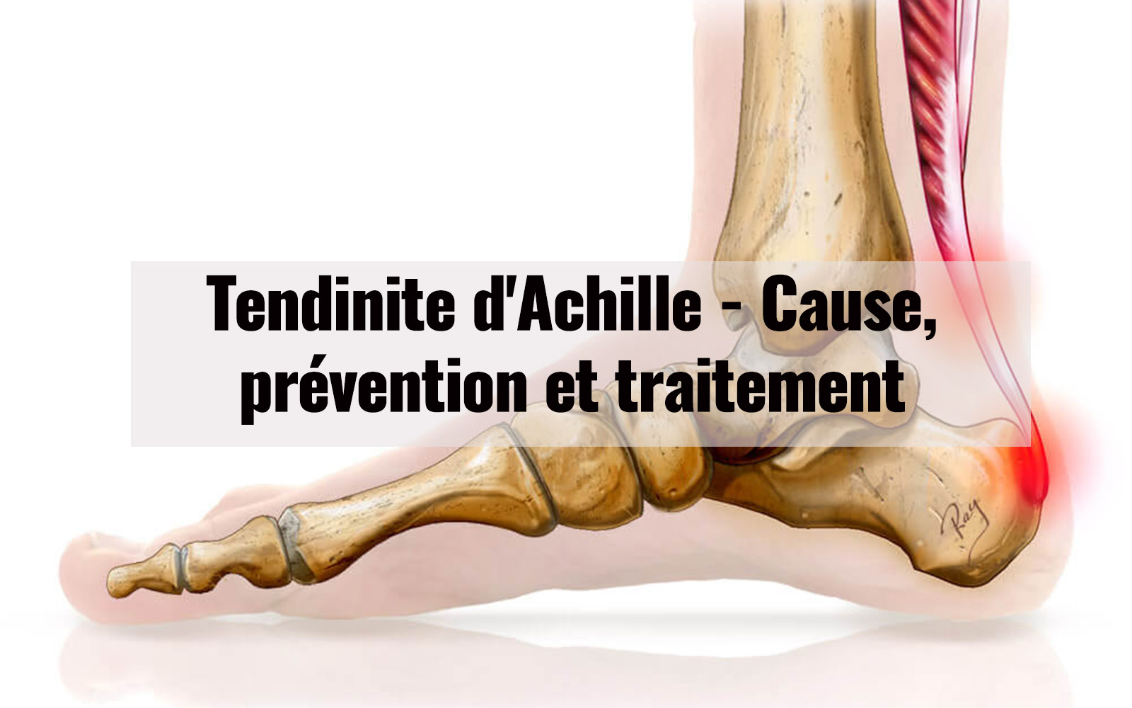 Tendinite d’Achille – Cause, prévention et traitement